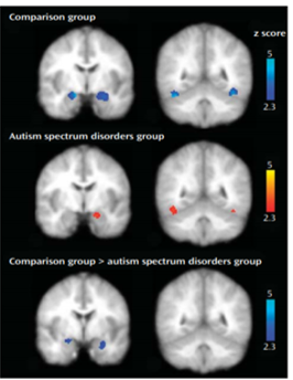 autism brain amygdala habituation