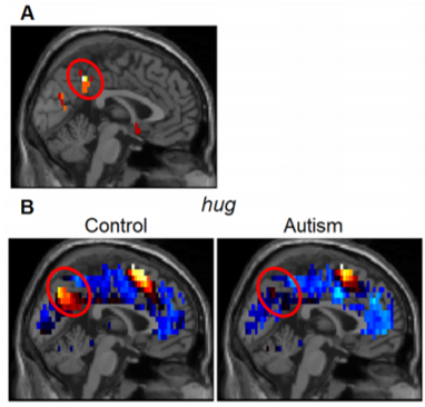 autism brain activation precuneus