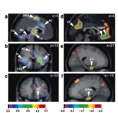 music and brain reward system activation